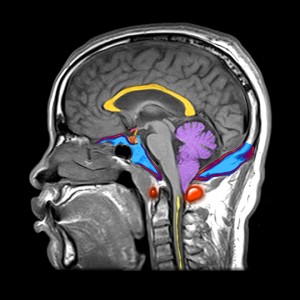 chiari malformation MRI scan