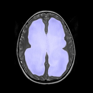 Hydrocephalus MRI scan