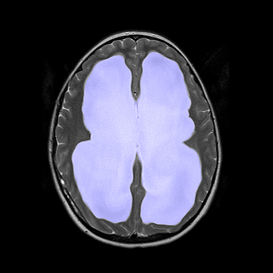 SciSource_BM1634 Hydrocephalus MRI scan