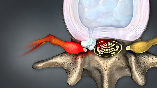 herniated-disc