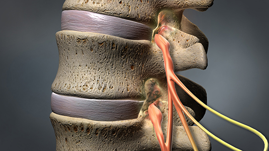 lumbar-spinal-stenosis