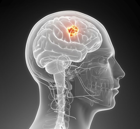 Brain tumor highlighted in brain